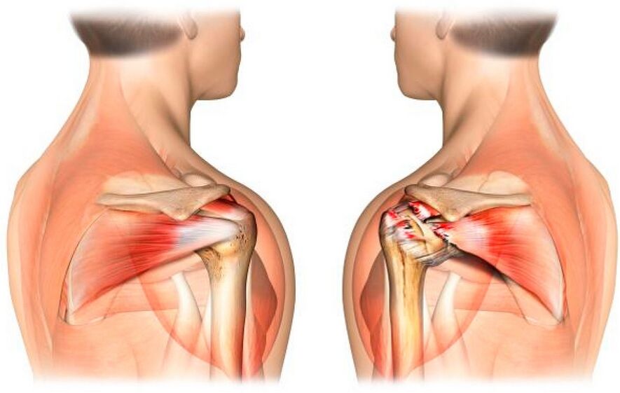 Здоровое плечо, пораженное остеоартритом
